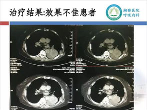 胸腔热灌注的注意事项,恩度胸腔灌注注意事项,胸腔灌注化疗注意事项