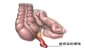 恶性阑尾炎手术后注意事项