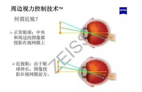 近视镜片的基础知识