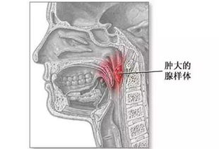 小儿腺样体肥大的基础知识