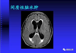 儿童头颅mri基础知识