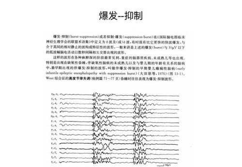 正常脑电图基础知识